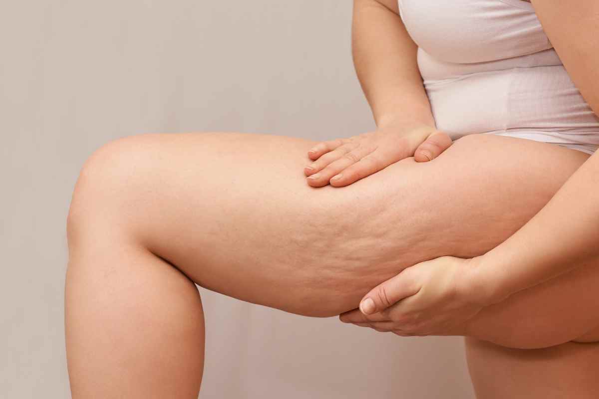 Ritenzione idrica estiva, i consigli degli esperti